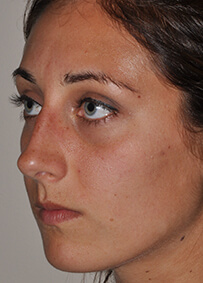 Rhinoplasty