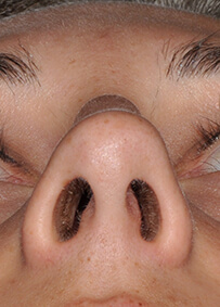 Rhinoplasty