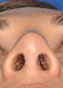 Rhinoplasty