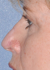 Nose Reconstruction