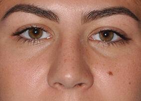 Rhinoplasty