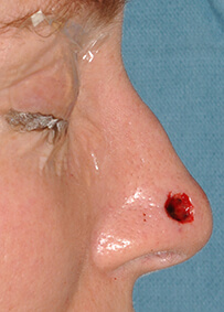 Nose Reconstruction