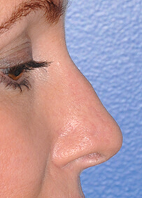 Nose Reconstruction