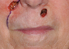 Lip Reconstruction