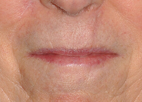 Lip Reconstruction
