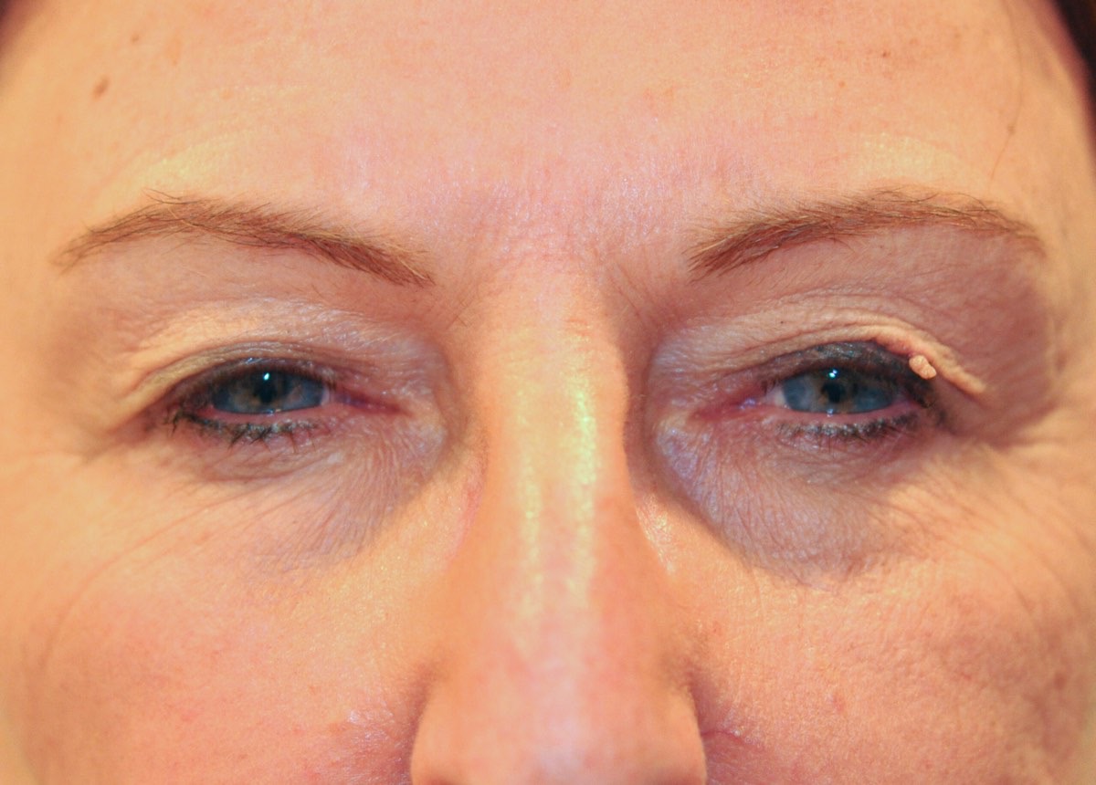 Blepharoplasty (Eyelid Lift)