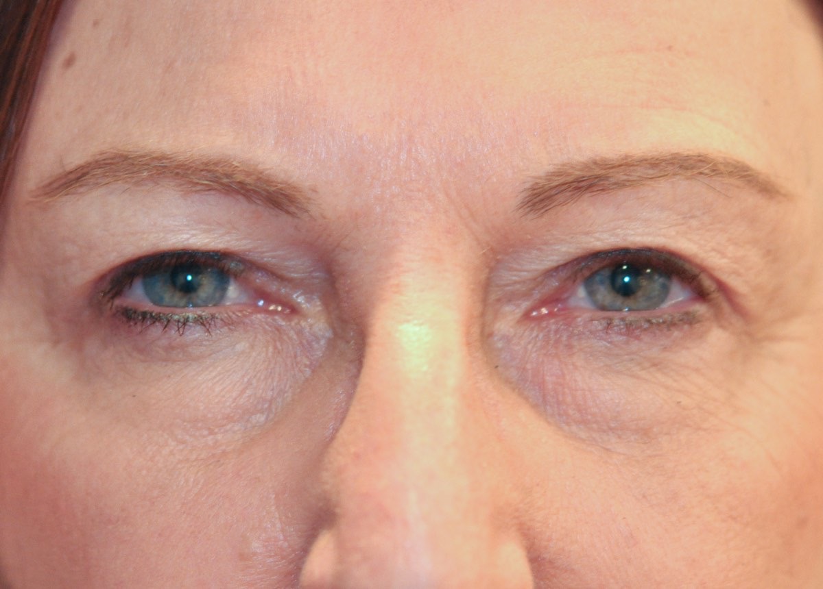 Blepharoplasty (Eyelid Lift)