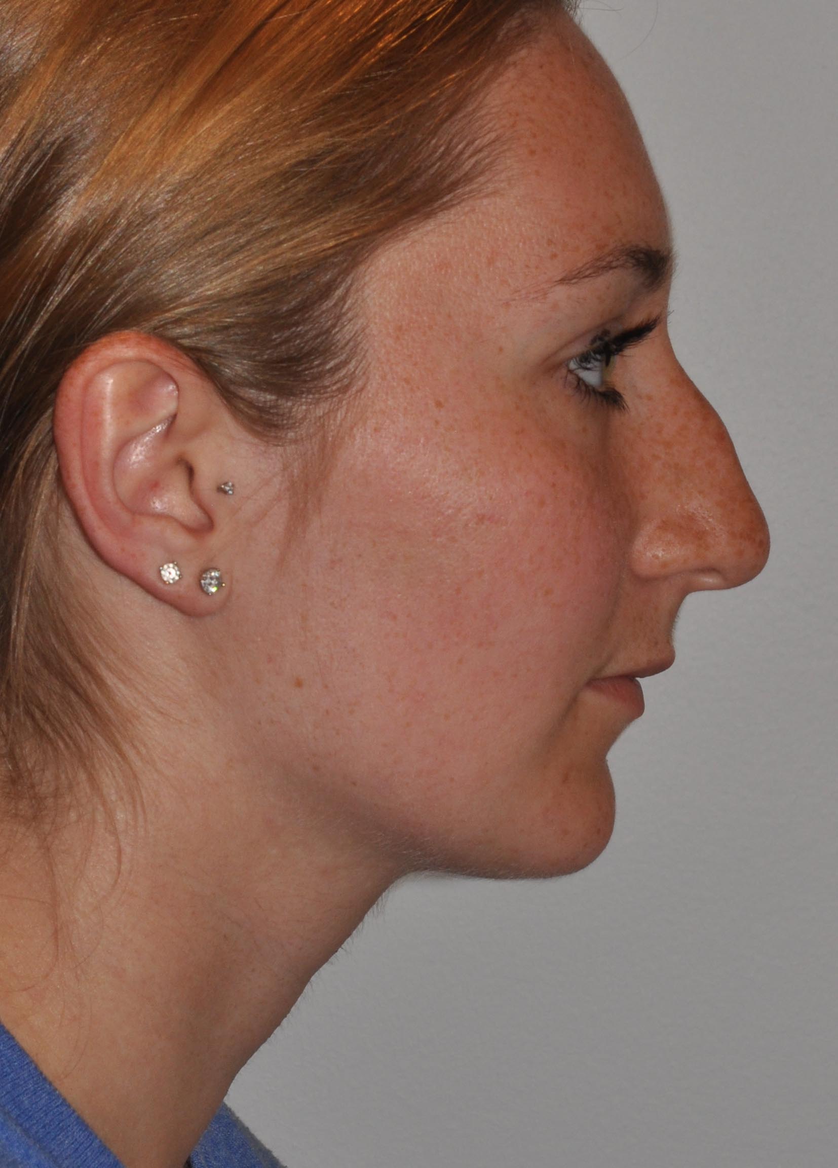 Rhinoplasty