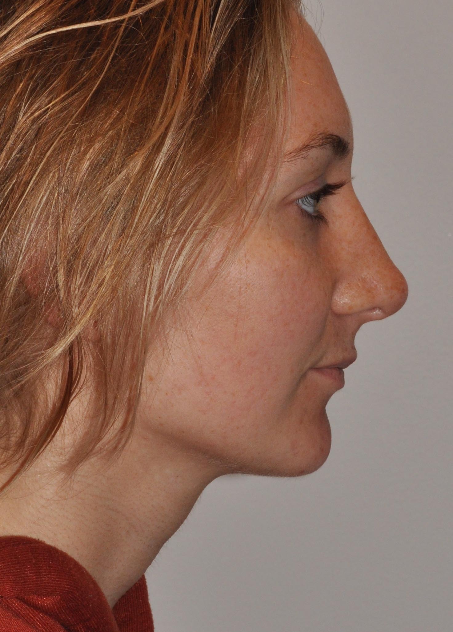 Rhinoplasty