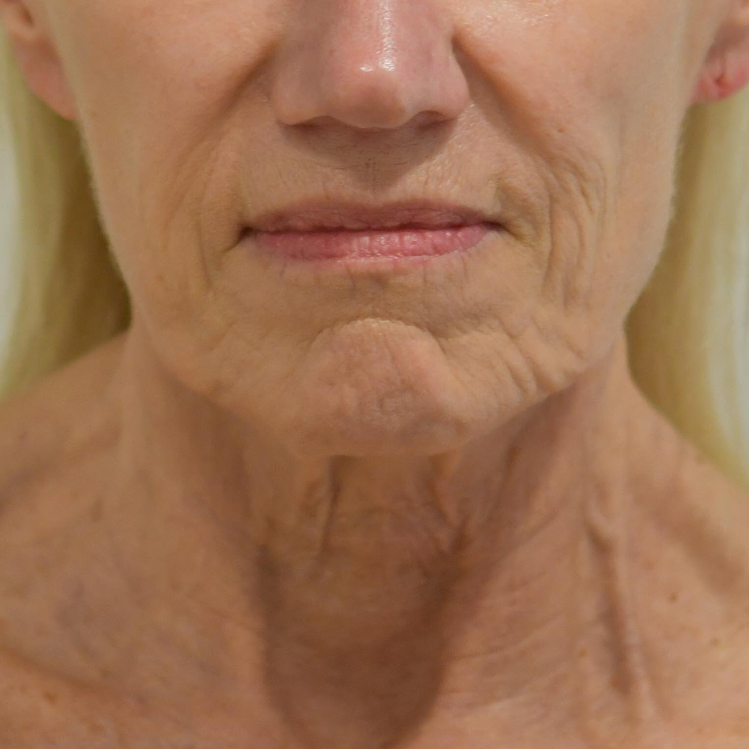 Face & Neck Lift