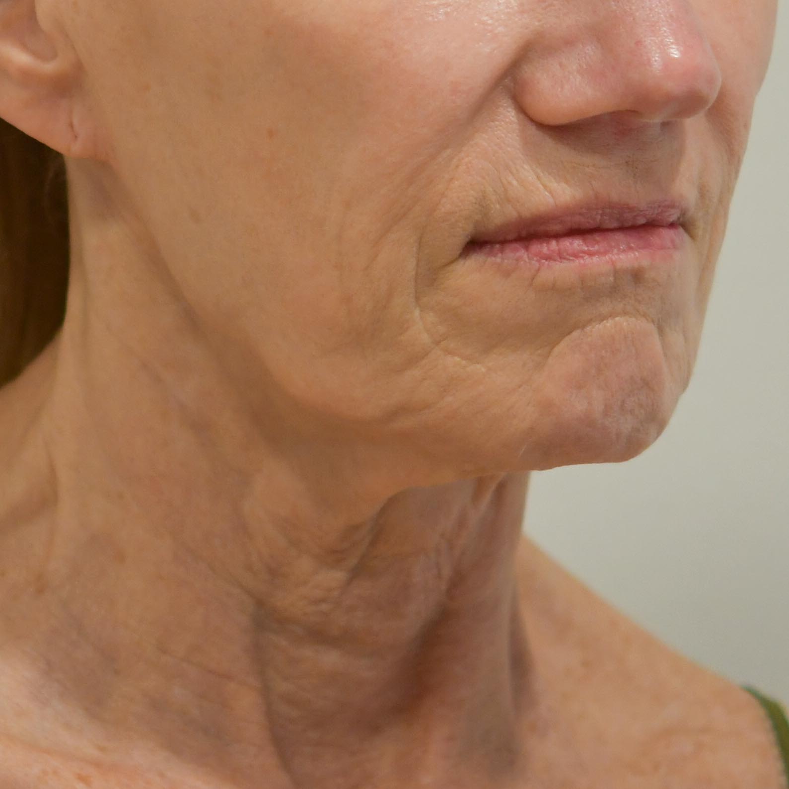 Face & Neck Lift