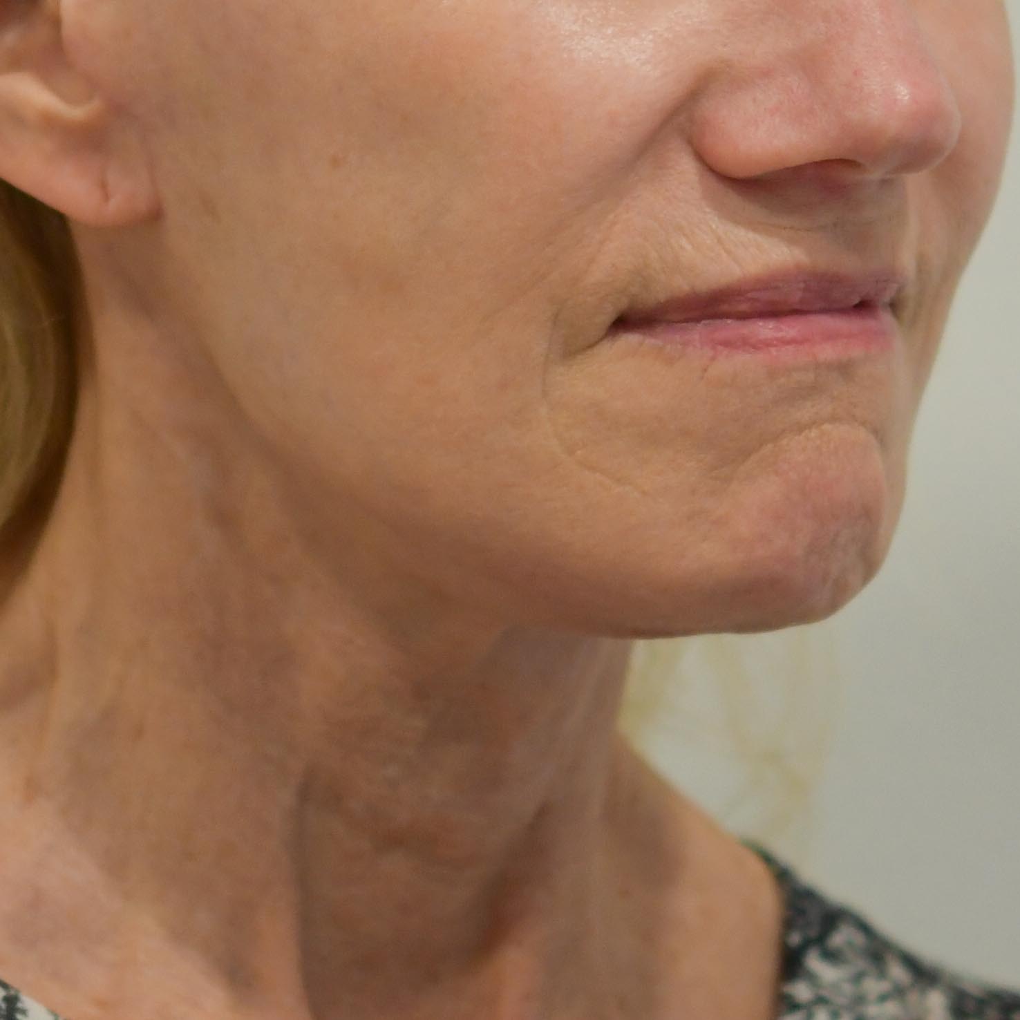 Face & Neck Lift