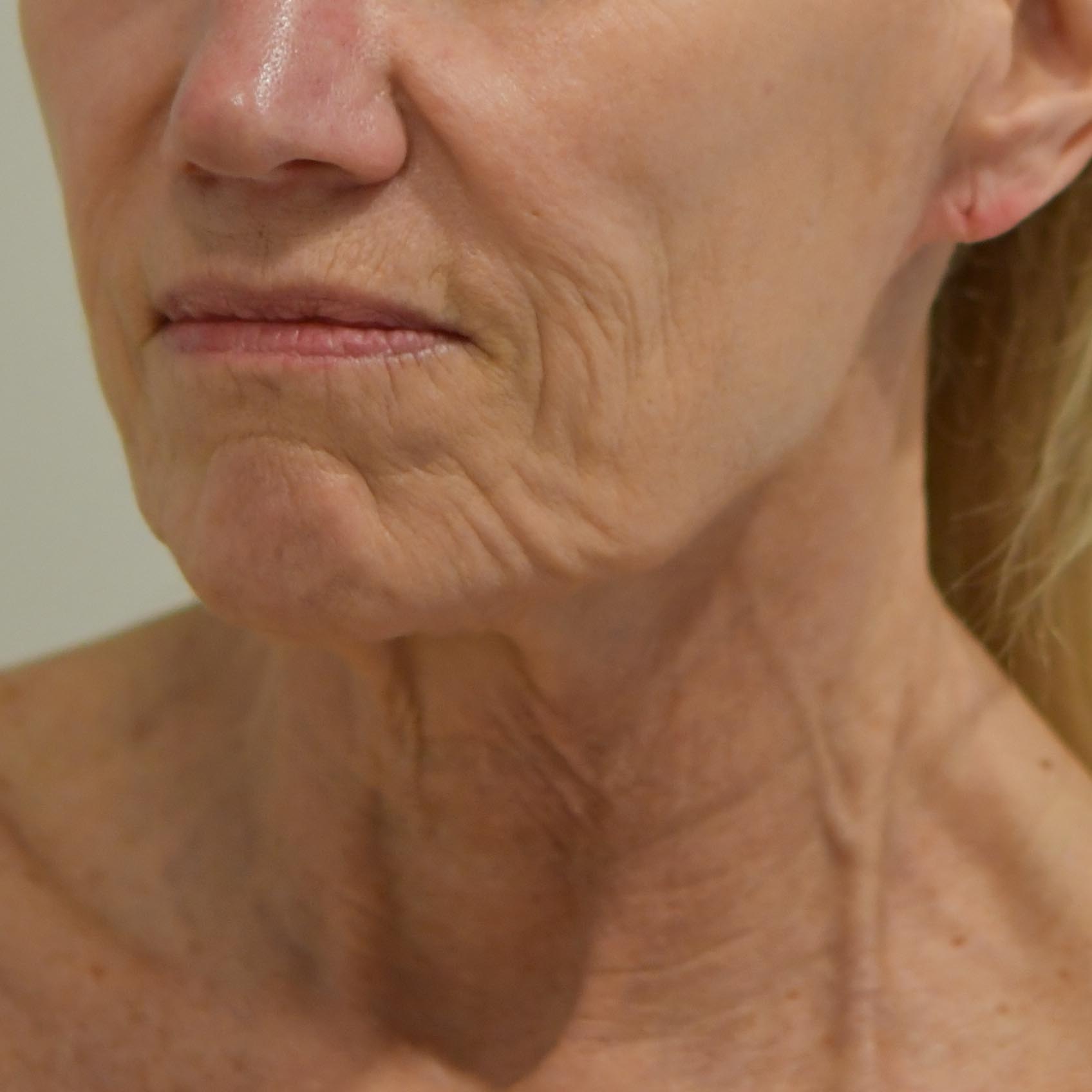 Face & Neck Lift