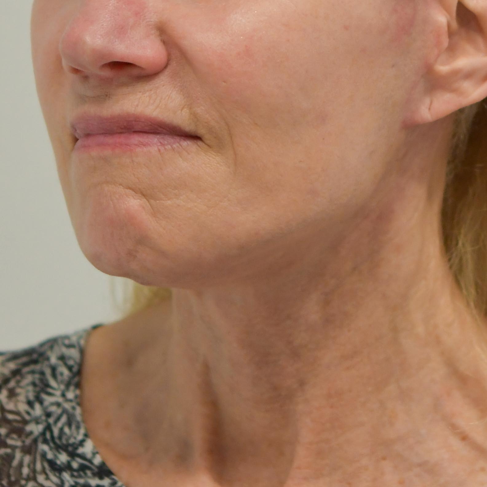 Face & Neck Lift