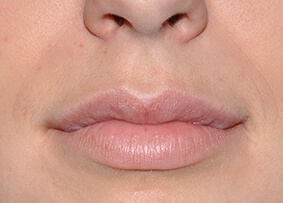 Lip Reconstruction