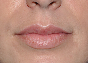 Lip Reconstruction