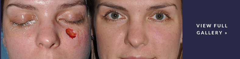 Eyelid & Cheek Reconstruction Gallery