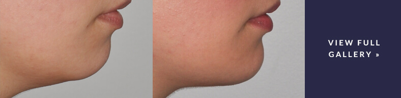 Chin Augmentation Gallery