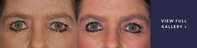 Brow Lift Gallery