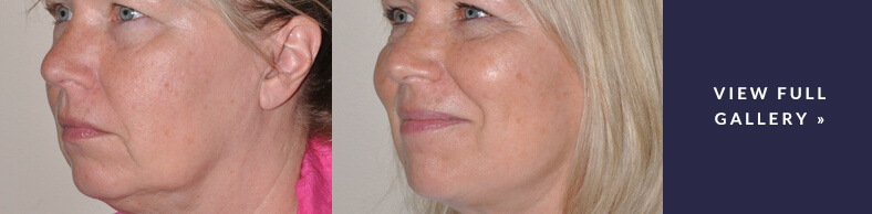 Face/Neck Lift Gallery