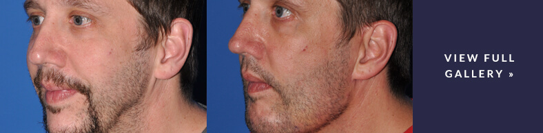 Facial Fat Grafting Gallery