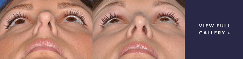 Nasal Surgery For Breathing Gallery