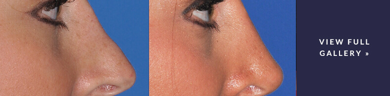 Revision Rhinoplasty Gallery