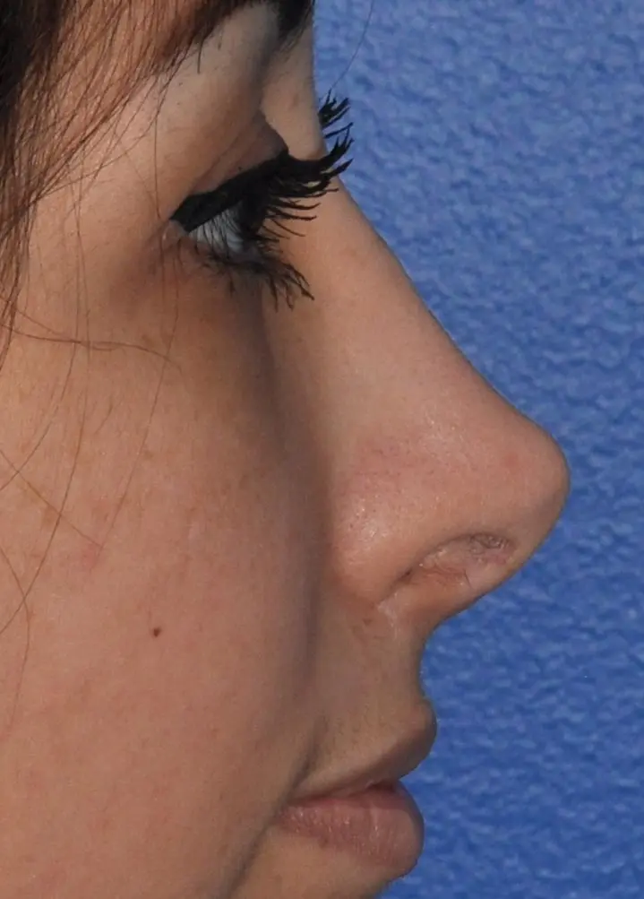 Revision Rhinoplasty