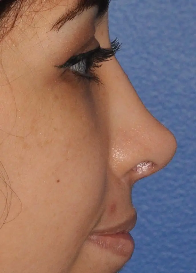 Revision Rhinoplasty