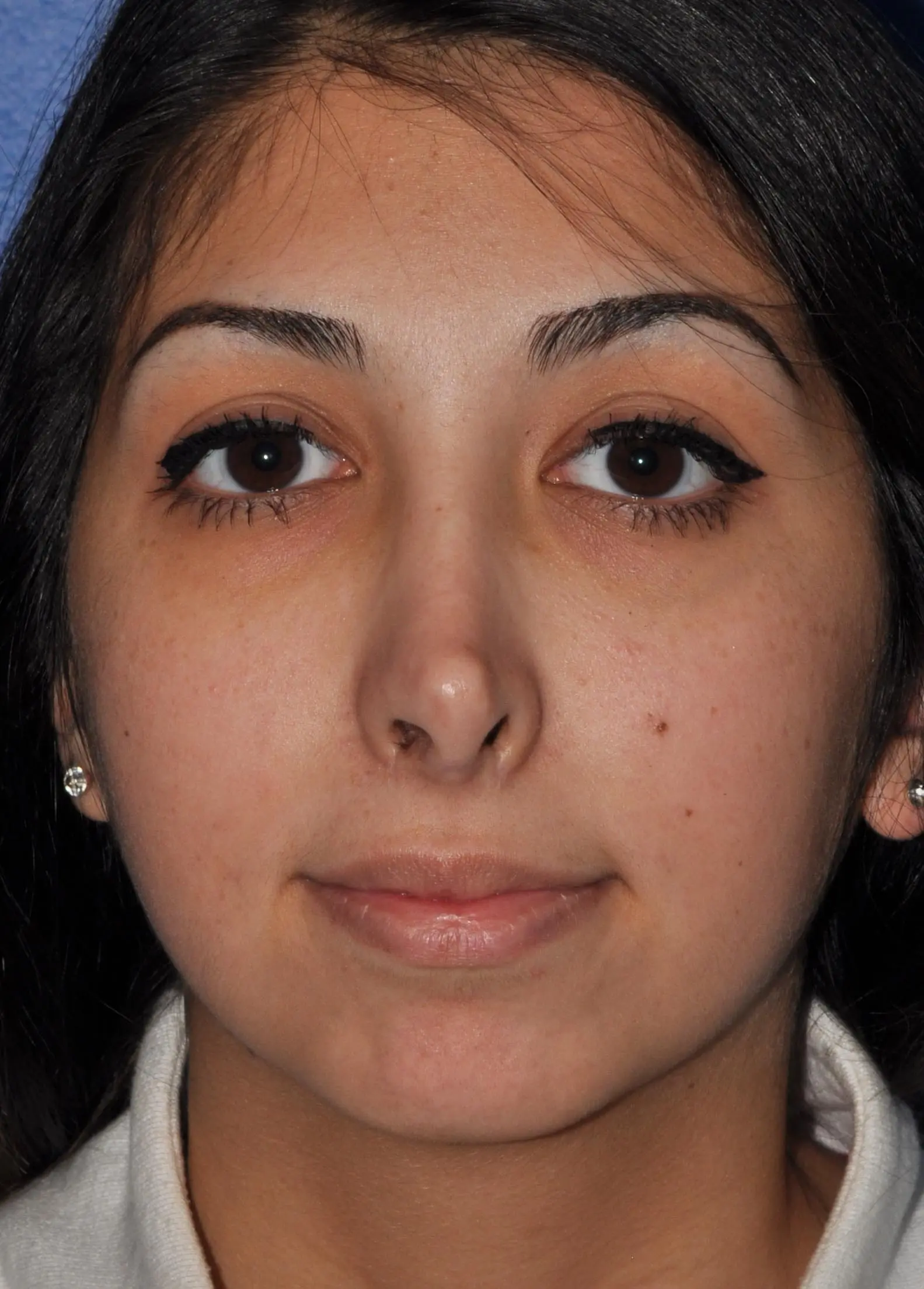 Revision Rhinoplasty