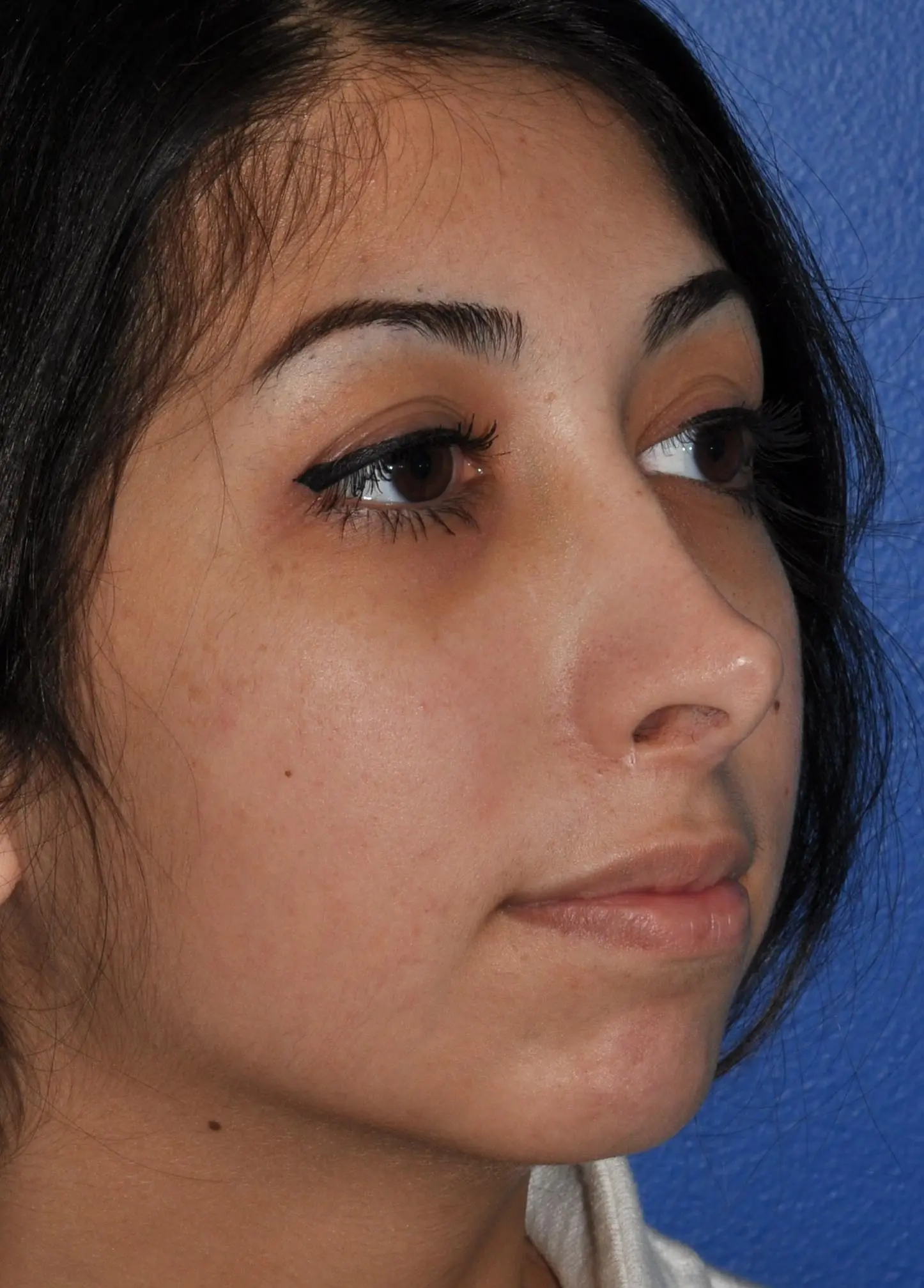 Revision Rhinoplasty