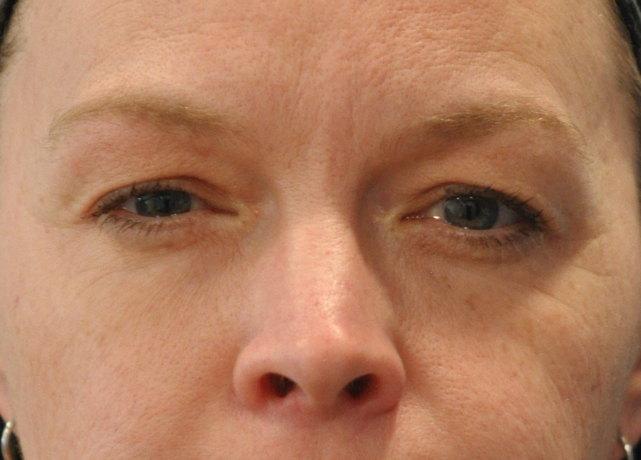 Blepharoplasty (Eyelid Lift)