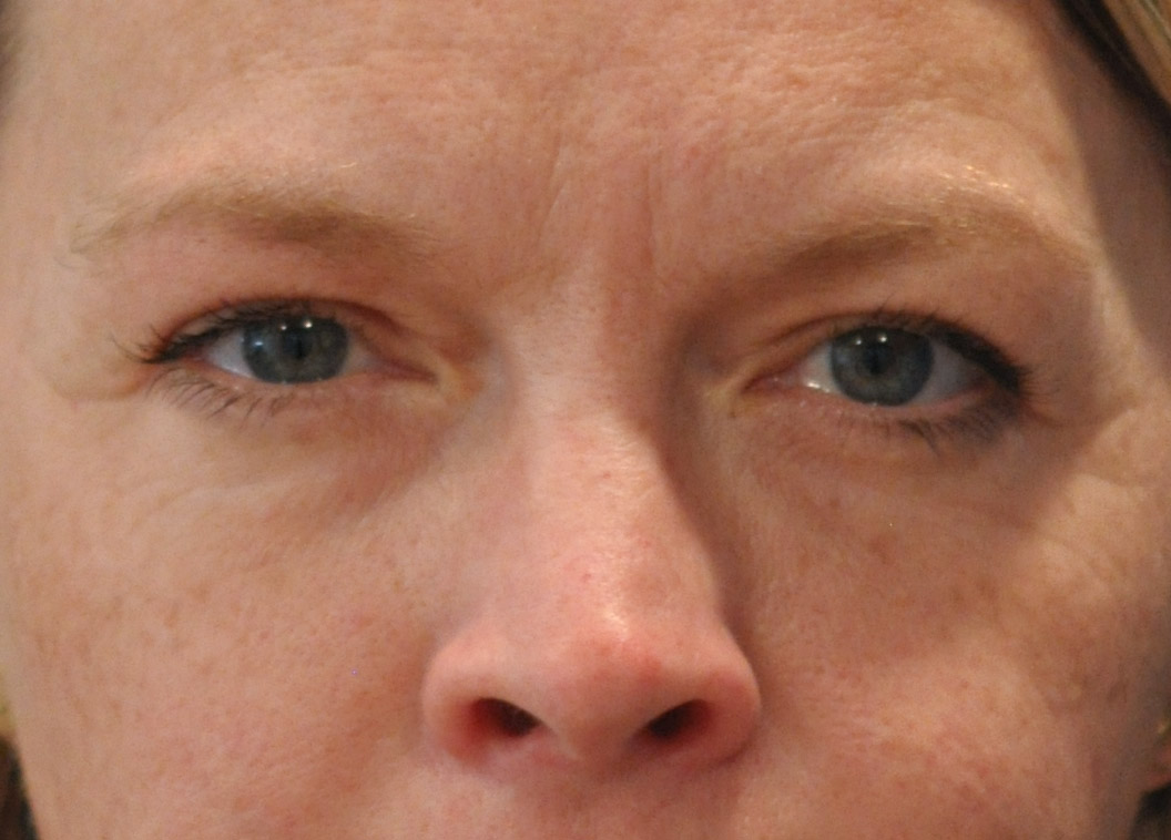 Blepharoplasty (Eyelid Lift)