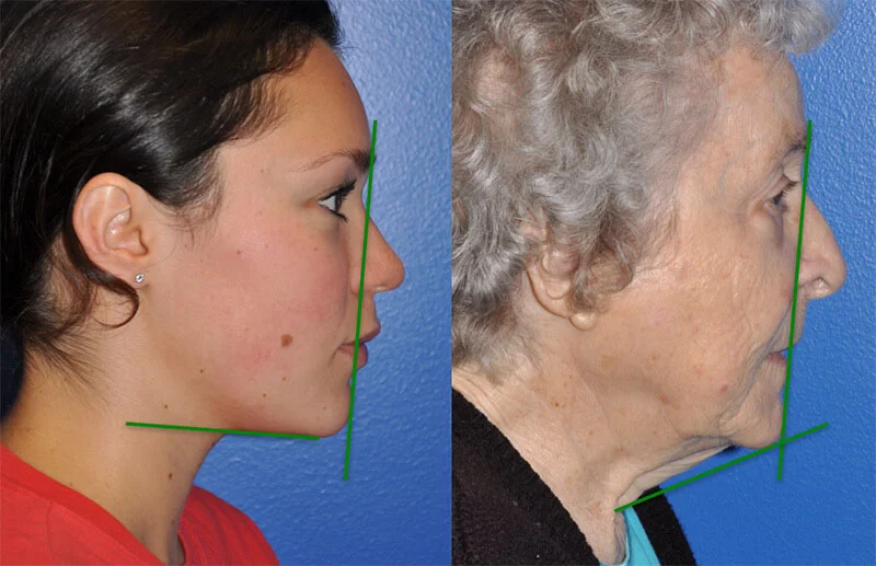 Photo showing a younger woman and an older woman demonstrating the affects age has on neck definition
