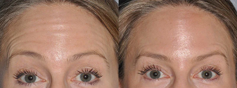 Forehead of a woman before and after BOTOX procedure, demonstrating how BOTOX eliminates wrinkles