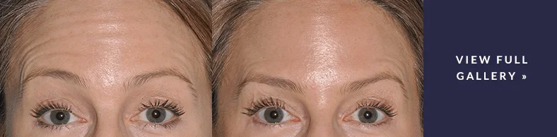 Real patient before and after photo BOTOX procedure Seattle