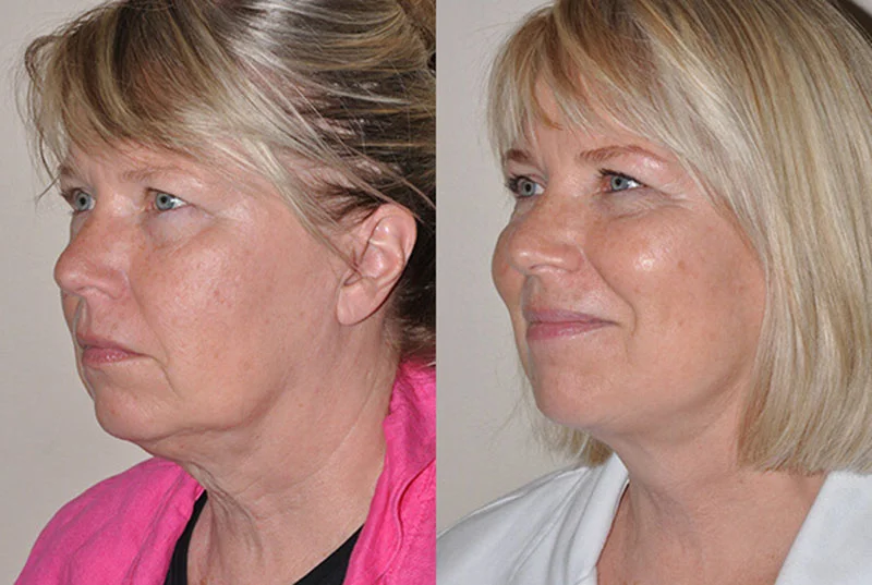 Real patient results showing more definition after a neck lift procedure