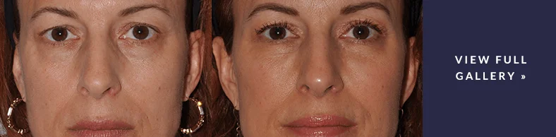 Real patient results - before and after Facial Fillers procedure photos Seattle
