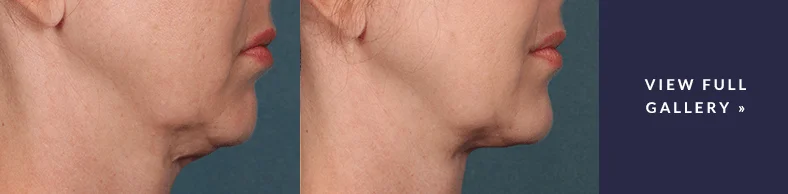 Real patient results - Kybella non-surgical procedure Seattle