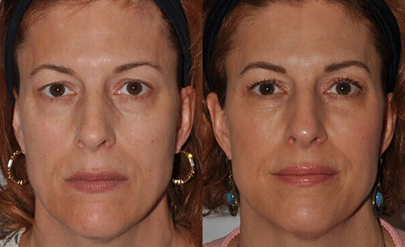 Before and after photo demonstrating the effects of cheek fillers