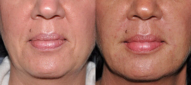 Before and after photo showing the affects of lower face filler
