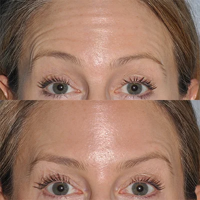 Real patient BOTOX results - Seattle