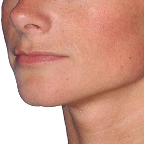 Real patient Chin Augmentation procedure Seattle