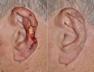 Real patient before and after photo ear reconstruction Dr. Bhrany - Seattle 
