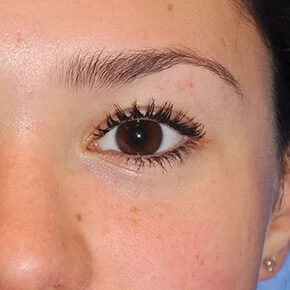 Real patient Eyelid Lift procedure Seattle