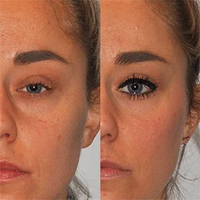 Real patient Facial Fillers results