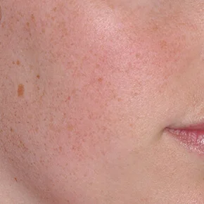 Real patient IPL Facial results