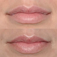 Real patient before and after photo lip reconstruction surgery Seattle