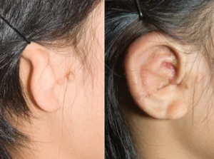 Real patient Microtia before and after photos - Seattle 