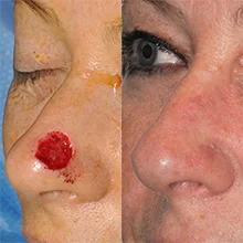 Real patient before and after photo showing nasal reconstruction Seattle